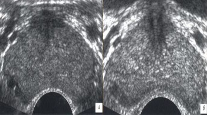echografie voor en na de behandeling met Prostovit-druppels
